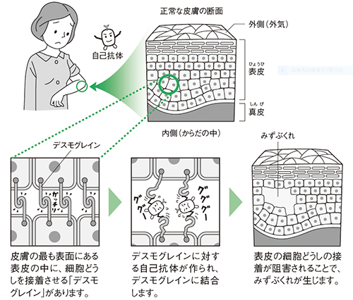 天疱瘡の原因