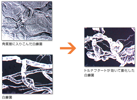 菌 白癬