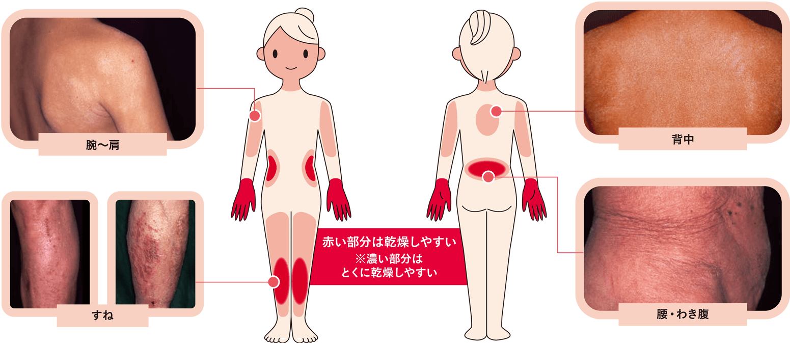 図１　体で乾燥しやすい部位
