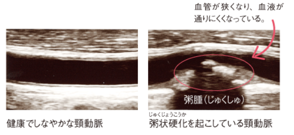 頚動脈のエコー画像