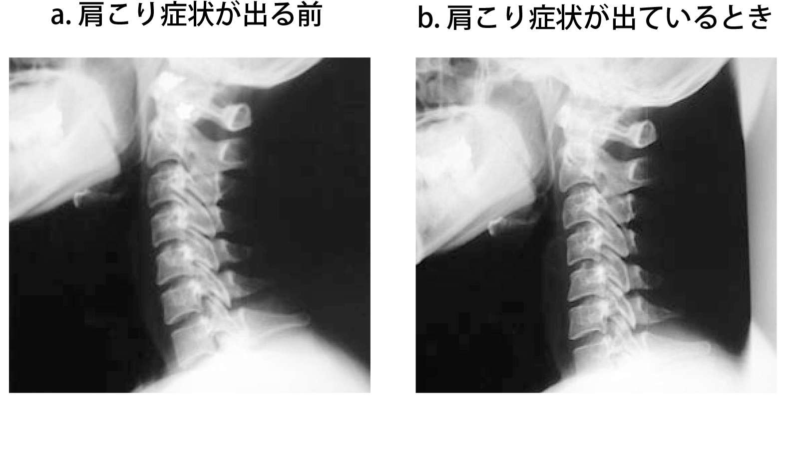 図４ 肩こりと首の骨の関係