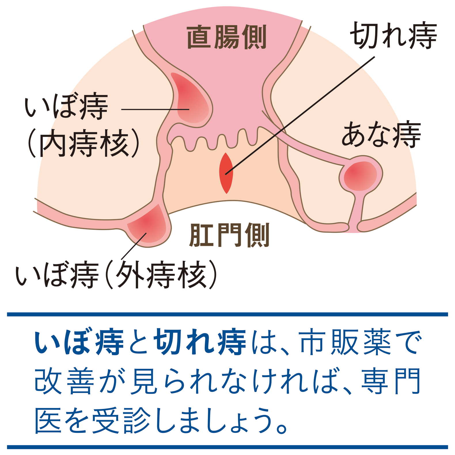 原因 痔 の