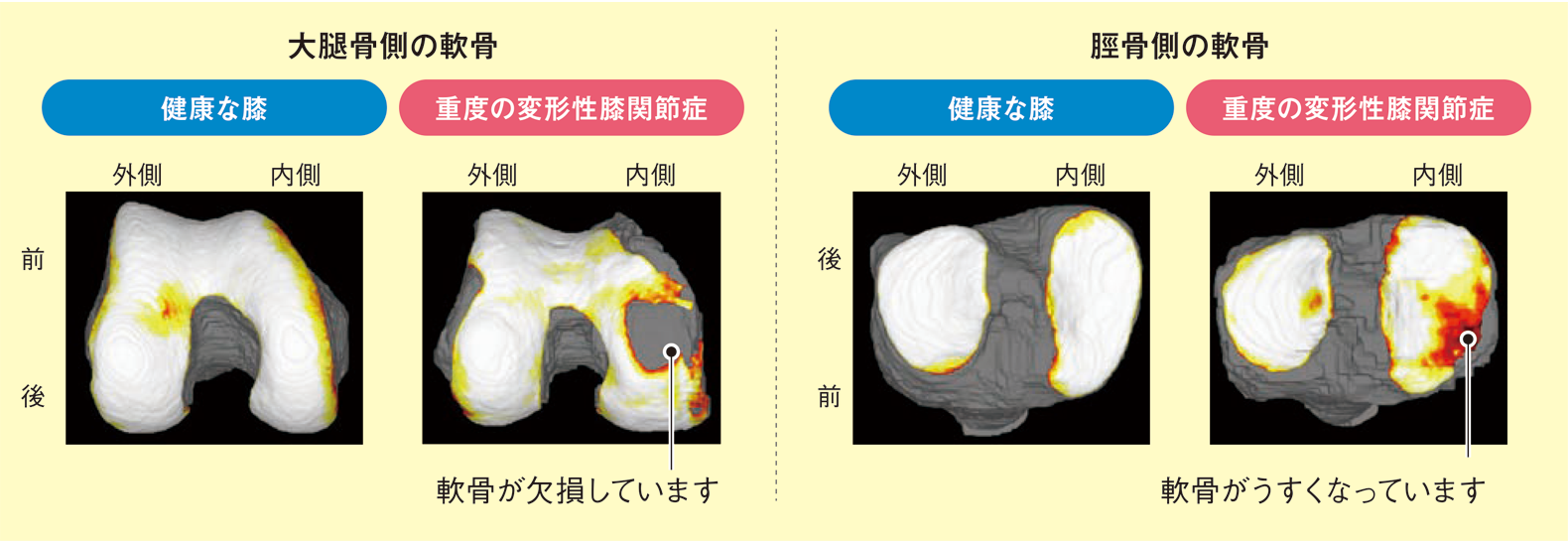 図４　MRIによる膝軟骨の三次元画像