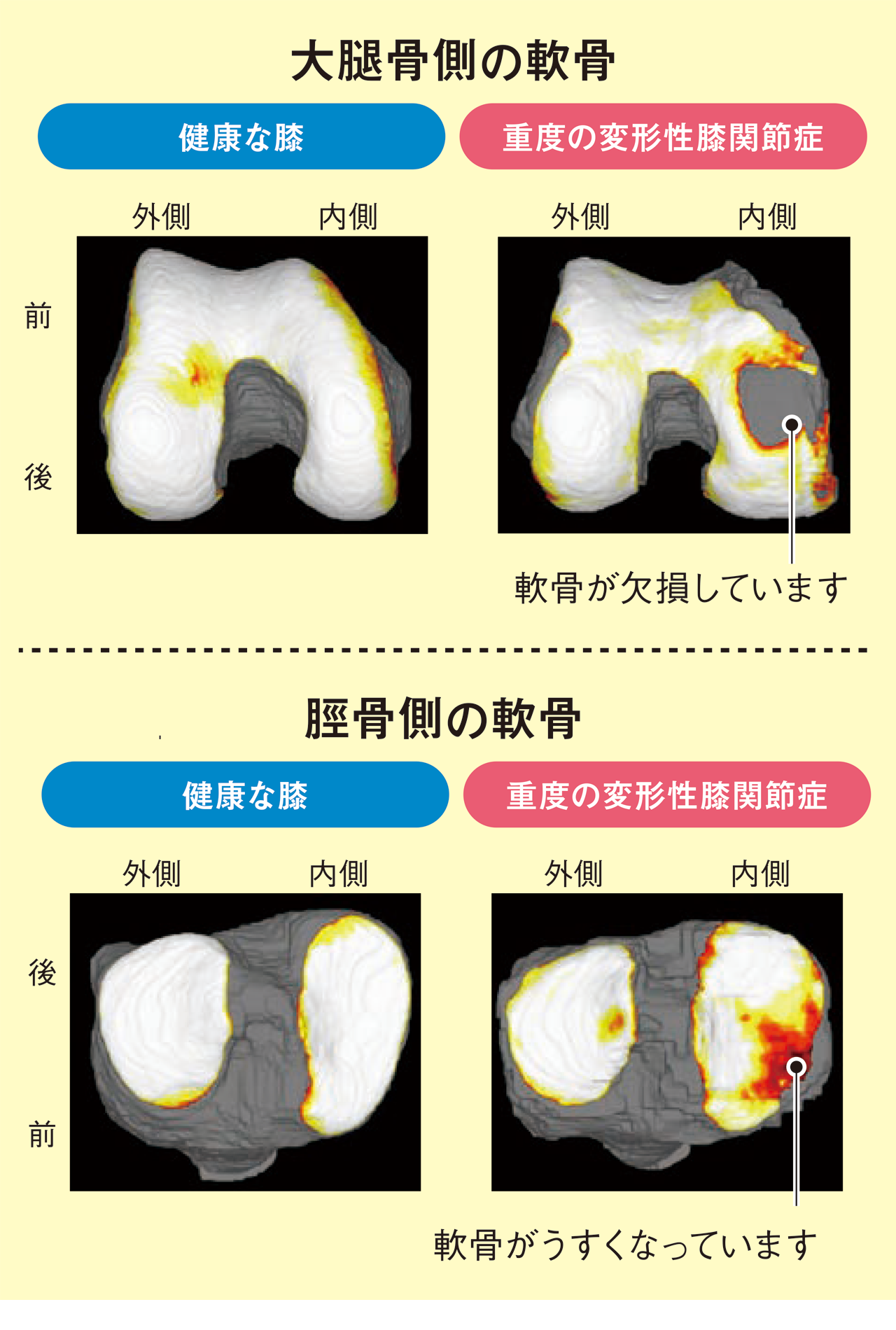 図４　MRIによる膝軟骨の三次元画像
